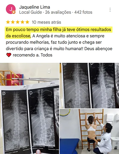 escoliose-dep (1)